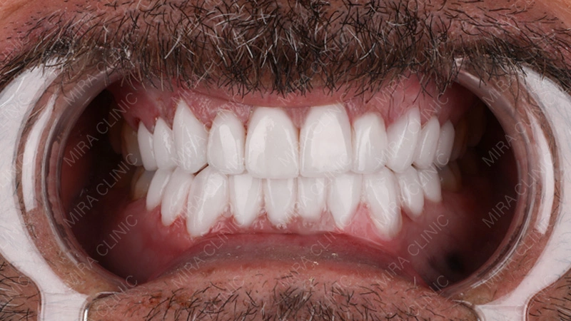 natural veneers